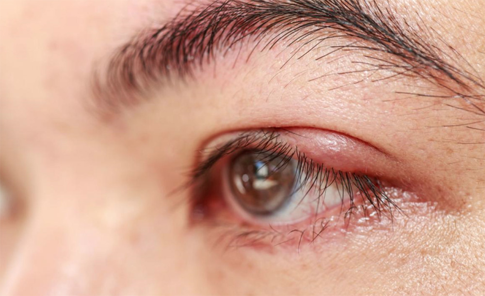 Chalazión y orzuelo