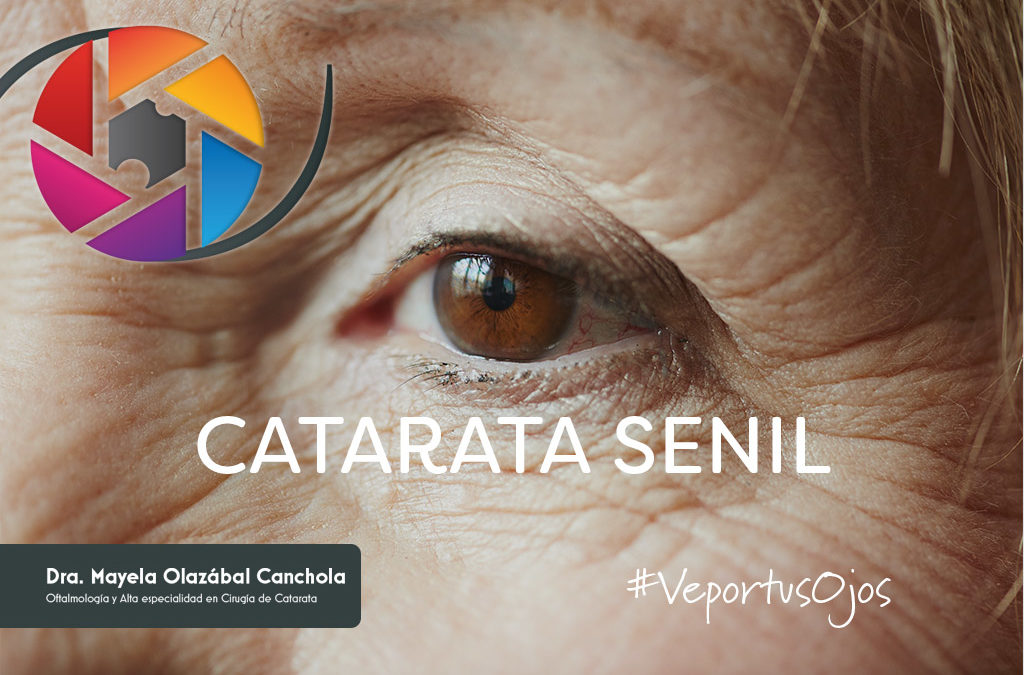 Catarata Senil