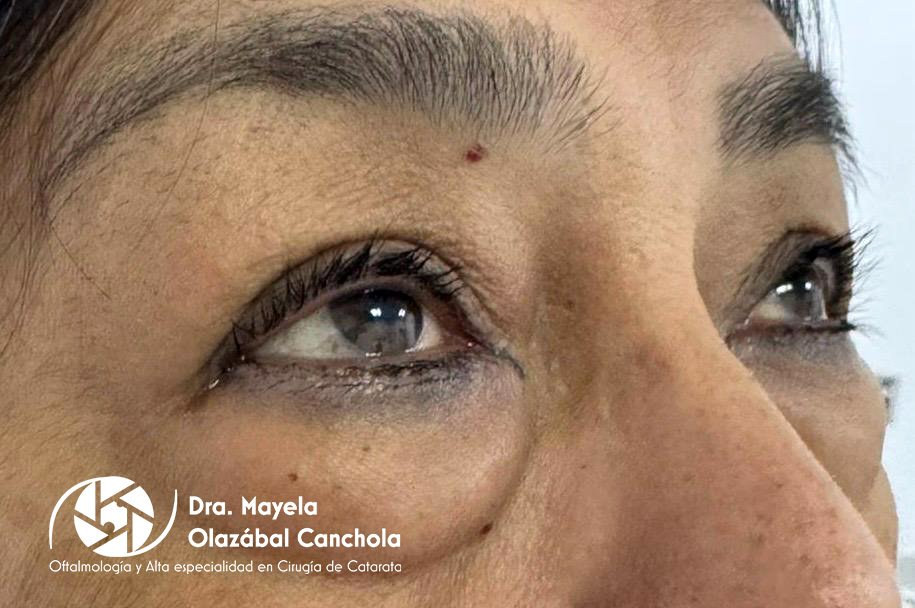 Blefaropastia superior e inferior